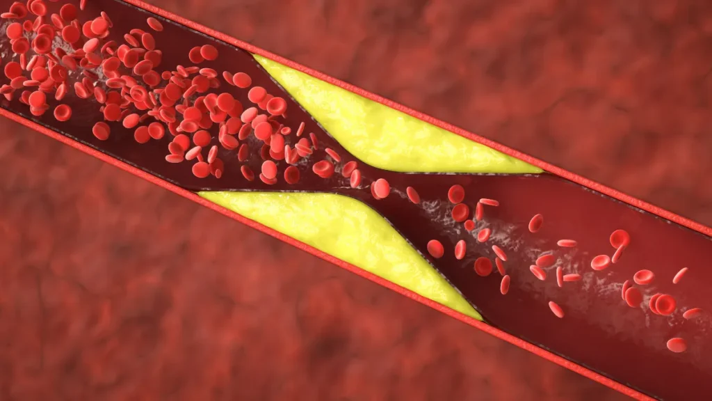 Doença arterial obstrutiva periférica: entendendo os sinais e cuidando da sua saúde vascular