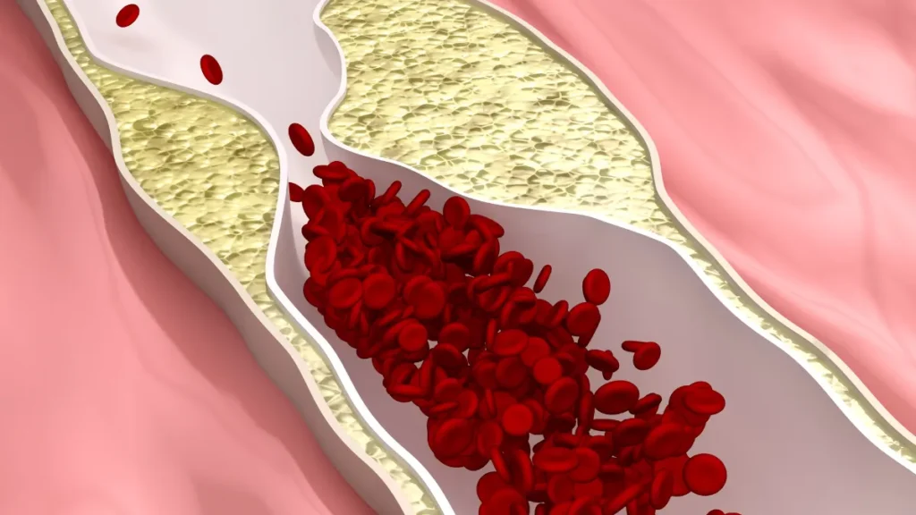 Doença arterial obstrutiva periférica: entendendo os sinais e cuidando da sua saúde vascular