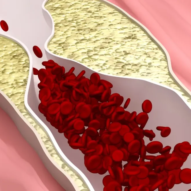 Doença arterial obstrutiva periférica: entendendo os sinais e cuidando da sua saúde vascular