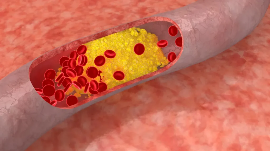 Colesterol alto: entendendo os riscos silenciosos e cuidando da sua saúde cardiovascular