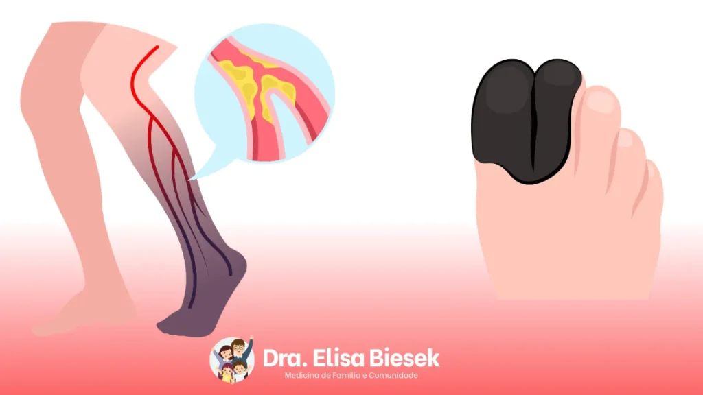 Doença arterial obstrutiva periférica: entendendo os sinais e cuidando da sua saúde vascular