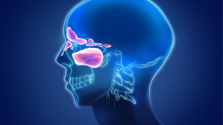 Sinusite: Entenda os Sintomas, Tratamentos e Dicas para Prevenção