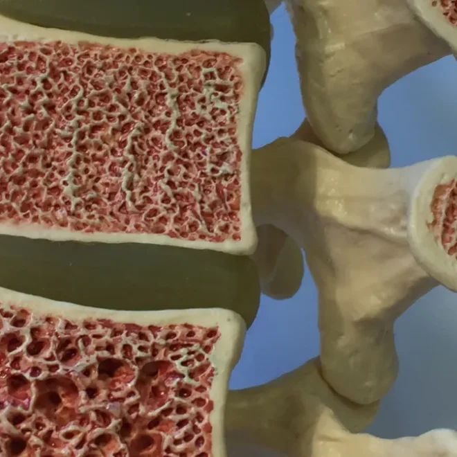7 mitos sobre osteoporose que você precisa desvendar