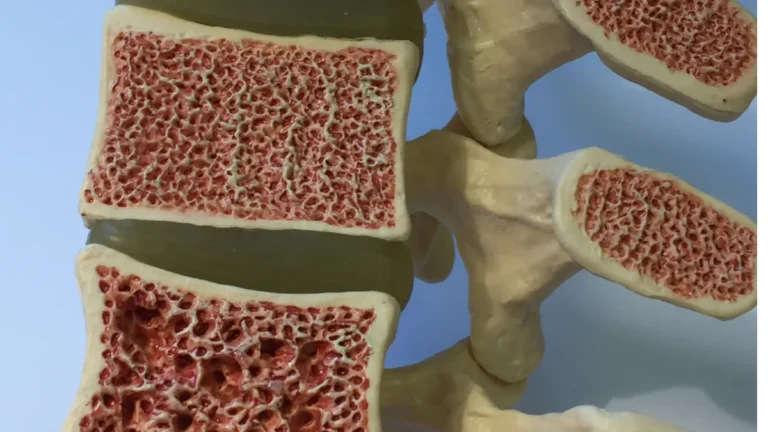 7 Mitos Sobre Osteoporose Que Você Precisa Desvendar