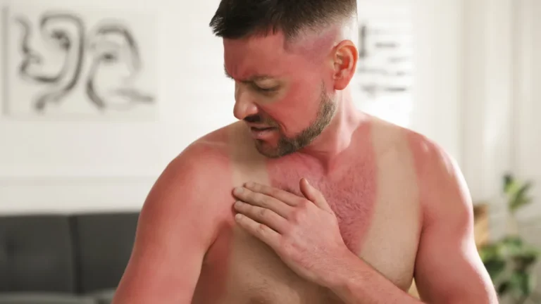 Queimaduras: Prevenir e Tratar com Segurança