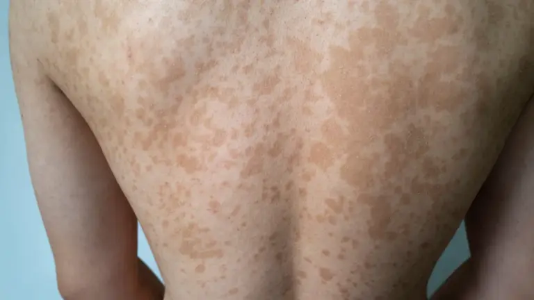 Pano Branco: Prevenção, Tratamento e Cuidados Essenciais