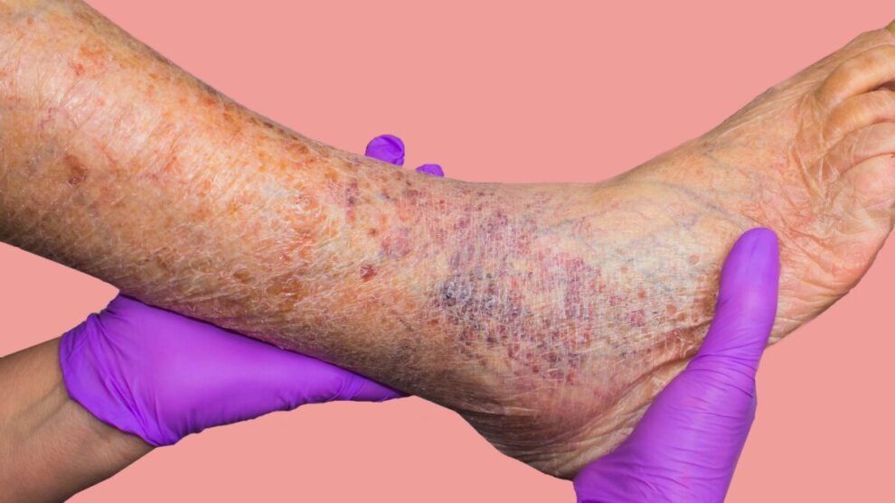 Um guia para os cuidados e prevenções Contra Varizes