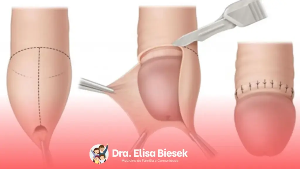 Fimose: o que é, sintomas, tratamentos e quando procurar ajuda médica