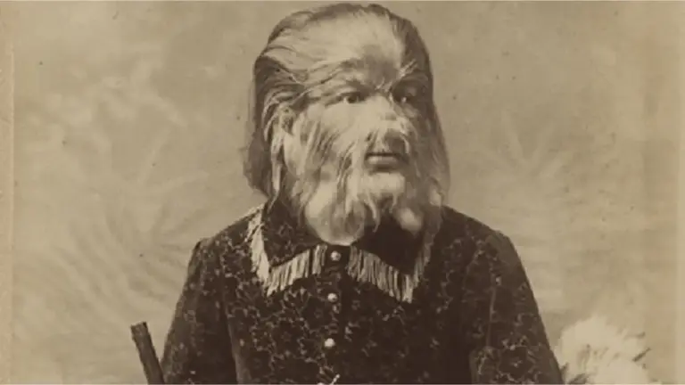 Hipertricose: Conheça a condição que acelera o crescimento dos pelos do corpo