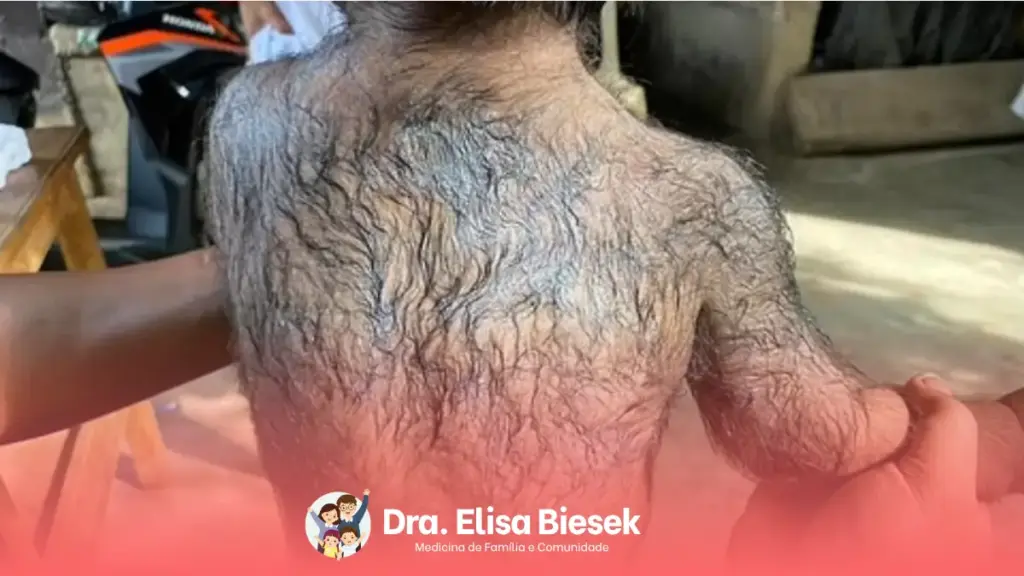Hipertricose: conheça a condição que acelera o crescimento dos pelos do corpo Hipertricose: conheça a condição que acelera o crescimento dos pelos do corpo