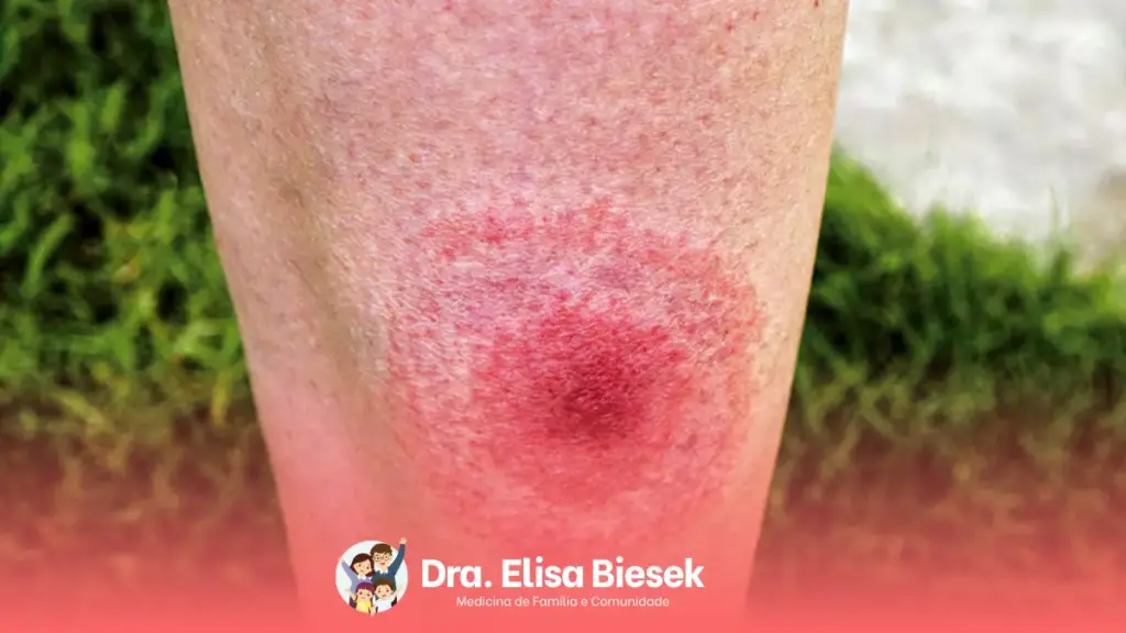 Doença de lyme: conheça essa doença do carrapato Doença de lyme: conheça essa doença do carrapato